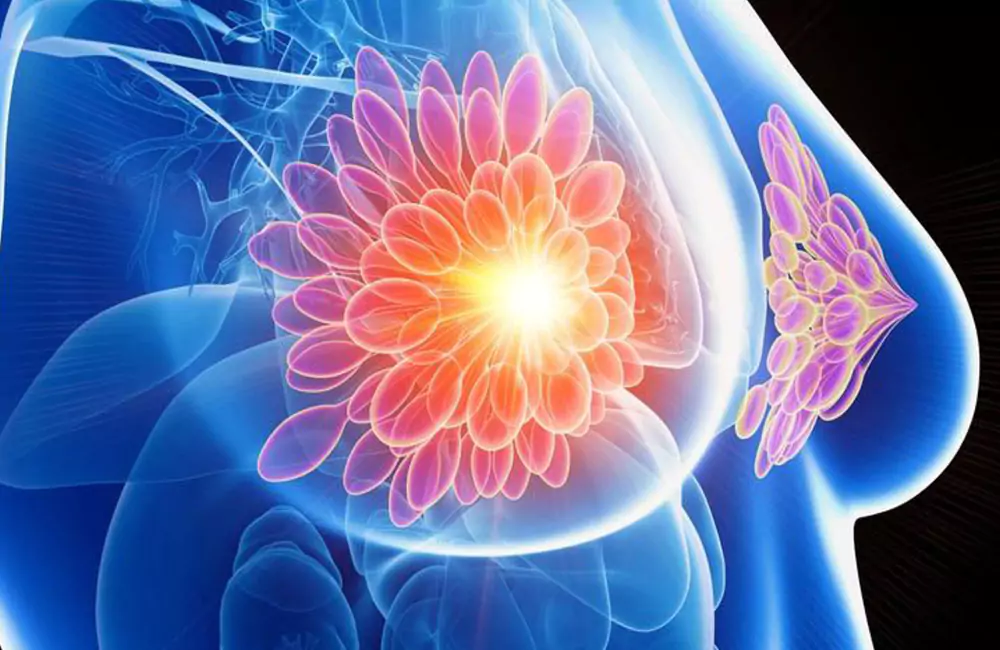 Breast Cancer